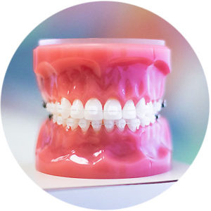 ceramic-braces